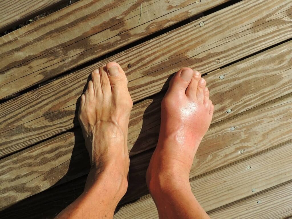 Image of gout from SolFoot
Epsom salt helps gout relief