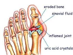 Illustration of gout
Epsom Salt therapy for gout