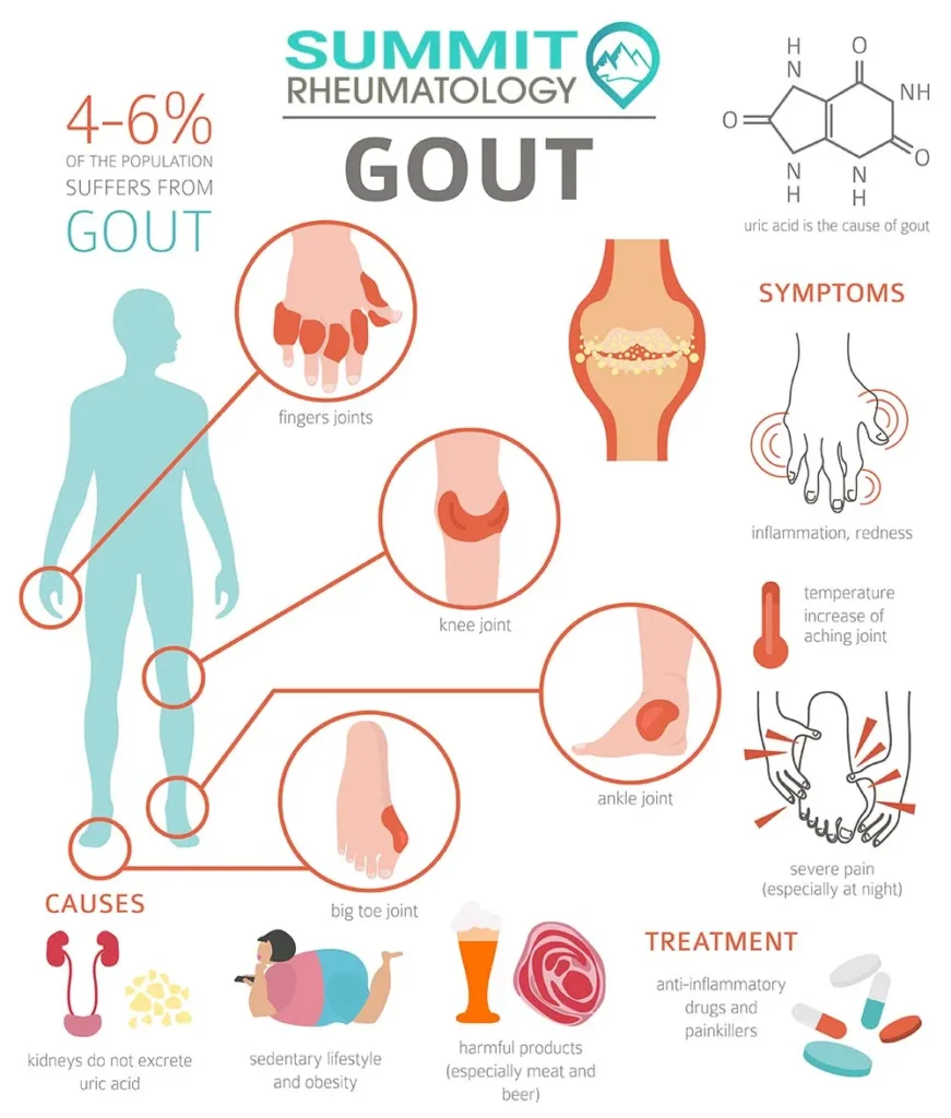 Summit Rheumatology image examples of gout (2)